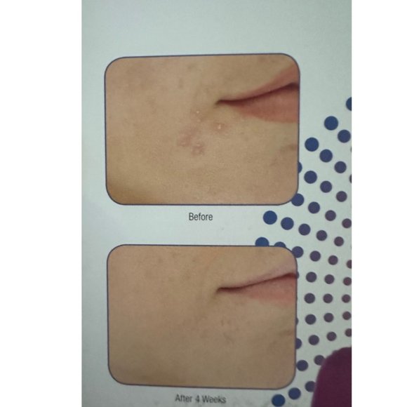 LightStim Professional Handheld LED Therapy for Acne - New Sealed - Picture 3 of 8